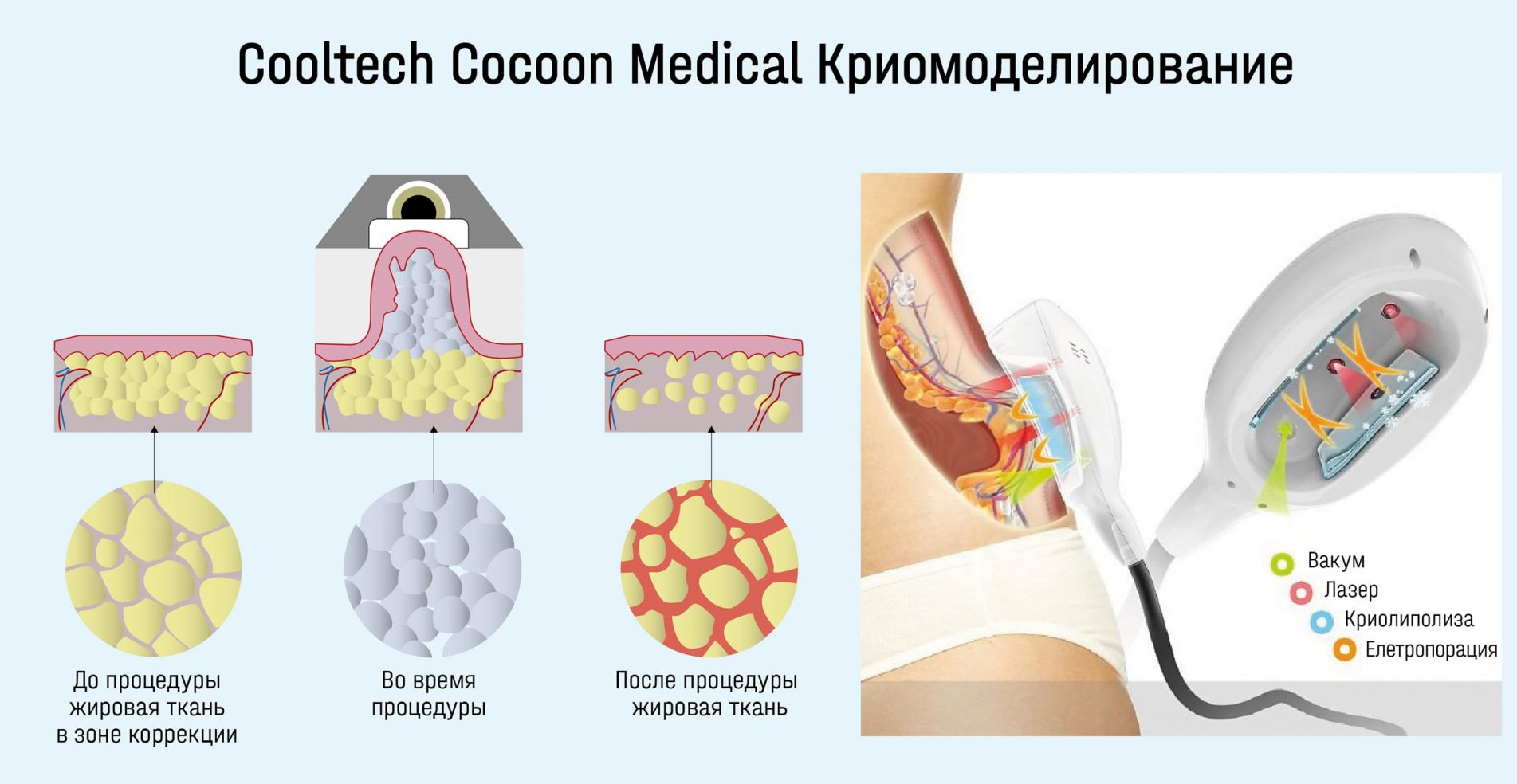 Криолиполиз показания